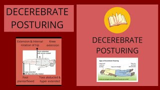 DECEREBRATE POSTUREAbnormal Posturing [upl. by Ylhsa]