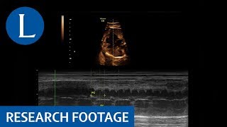 Fetal echocardiogram of a complete autoimmune congenital heart block [upl. by Hsitirb752]