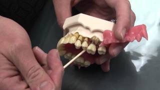 What is Periodontal Disease [upl. by Petulah131]