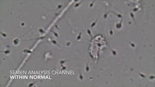 Semen Analysis  Within normal [upl. by Moreta]