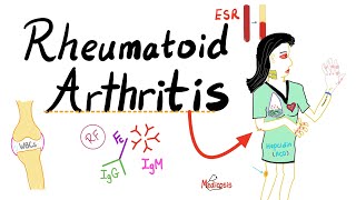 5 Warning Signs of Rheumatoid Arthritis [upl. by Ahselyt288]