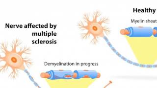 Imaging brain tumors  3  Oligodendrogliomas [upl. by Ocsinarf]