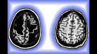 brain rewires itself after severe brain injury [upl. by Ydnolem]