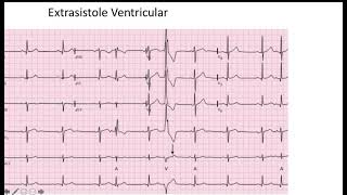 Extrasistole Ventricular EKG [upl. by Lyrahs162]