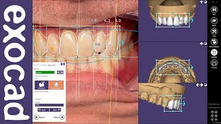 exocad Quick Guide Get the most out of your Smile Creator Module [upl. by Marvin]