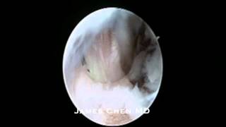 Arthroscopic Elbow Loose Body Removal amp Bone Spur Decompression [upl. by Nahej]