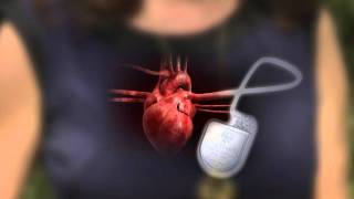 Pacemakers and ICDs The Shocking Truth [upl. by Leina]