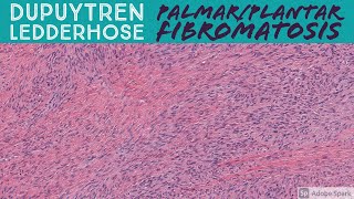 Palmar Fibromatosis Dupuytren Contracture amp Plantar Fibromatosis 5Minute Pathology Pearls [upl. by Rebmit751]