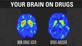 How addiction changes your brain [upl. by Aivek]