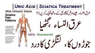 Arq Un Nisa  Gathiya  Joron  Langri Ke Dard Ka Ilaj  Uric Acid  Sciatica Treatment [upl. by Cathrine]