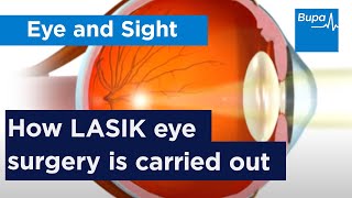 How LASIK eye surgery is carried out  Bupa Health [upl. by Hallie]