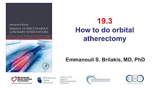 Transcatheter Aortic Valve Implantation TAVI [upl. by Asyram773]