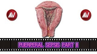 Puerperal Sepsis Part II [upl. by Ittocs861]