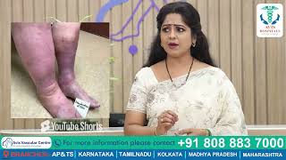 Avis Vascular Center  Varicose Veins Treatment By Highly Qualified Doctors At Affordable Cost [upl. by Otsugua]