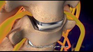 Cervical Disc Removal [upl. by Nnaitsirhc]