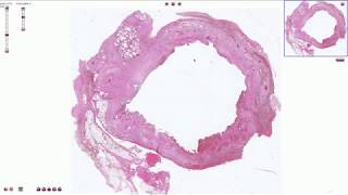 Chronic Cholecystitis  Histopathology [upl. by Hernardo]