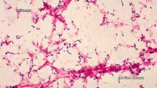 Bacterial Meningitis [upl. by Ameg]