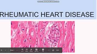 Rheumatic Heart Disease Pathogenesis Morphology Clinical features [upl. by Lledner]