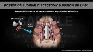 Anterior Cervical Discectomy and Fusion [upl. by Sualocin]