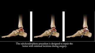 Subchondroplasty Procedure Bone Marrow Lesion Dr Warby [upl. by Nyleve]