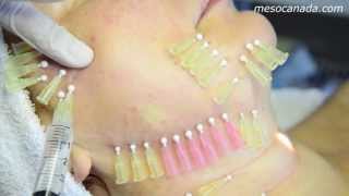 Thread Lifting 4D Mesotherapy [upl. by Remle]