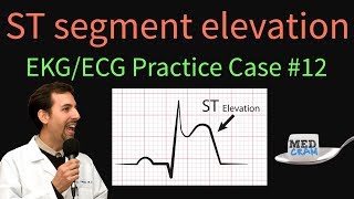 ST Elevation  EKG  ECG Interpretation Case 12 STEMI MI ACS [upl. by Layap723]