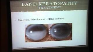 Band Keratopathy Interstitial Keratitis [upl. by Viehmann]