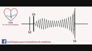 Soplo de la estenosis mitral [upl. by Ataner]