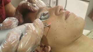 Freckles treatment with laser by Dr Syed Bilal Shams dermatologist and Cosmetologist [upl. by Song51]