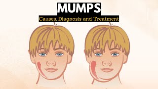 Mumps Causes Signs and Symptoms Diagnosis and Treatment [upl. by Kalindi]