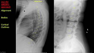 Cervical Spinal Cord Astrocytoma on MRI [upl. by Adnwahsar]