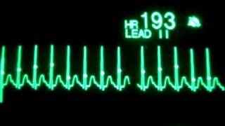 Taquicardia supraventricular con cardioversión sincronizada AS [upl. by Clementina]