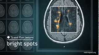 Demyelination Case Review  ADC Negative Multiple Sclerosis [upl. by Sharos993]