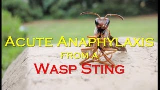 Acute Anaphylaxis from a Wasp Sting [upl. by Schott]