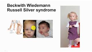 Conquering BeckwithWiedmann Syndrome Through Physical Therapy [upl. by Ahseined]