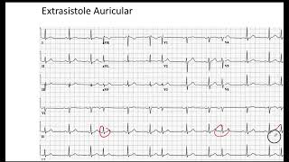 Extrasistole Auricular EKG [upl. by Yekim]