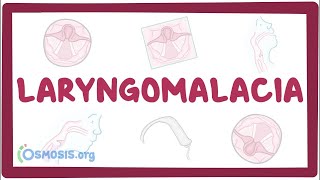 Tracheostomy vs Laryngectomy [upl. by Tannie]