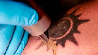 How Laser Tattoo Removal Works  Smarter Every Day 123 [upl. by Harrison]