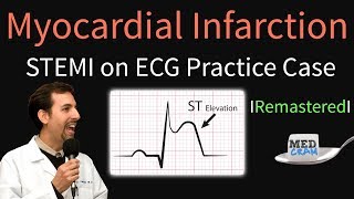 Myocardial Infarction  STEMI on ECG  Practice EKG [upl. by Dane]