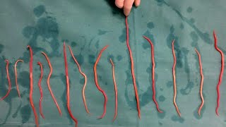 Doctors Remove 14 Roundworms From Woman [upl. by How]