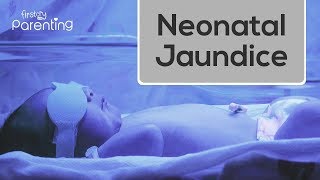 Blood Exchange Transfusion  Neonatal Jaundice [upl. by Jamila]