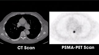 What is PSMAPET Scan Radioactive Imaging [upl. by Arella]