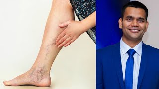 Varicose Veins  Get Rid of varicose Veins  Spider Veins  Naturally  Dr Vivek Joshi [upl. by Aidualc]