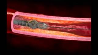 Pantheris Lumivascular Atherectomy Animation [upl. by Lander]