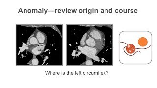 Describing coronary artery anomalies [upl. by Ecirtemed]