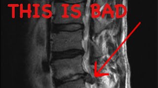 How to Read a Spine MRI [upl. by Reckford]