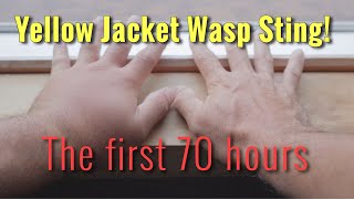 YELLOW JACKET WASP STING The first 70 hours [upl. by Nap]