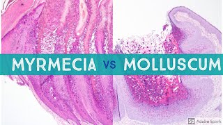 Molluscum vs Myrmecia Wart  Dermpath Lookalikes [upl. by Phil]