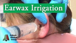 Ear Wax Irrigation  Auburn Medical Group [upl. by Laurita]