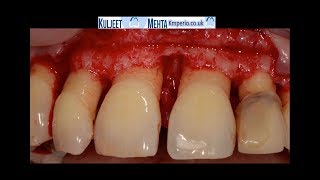 Periodontal Surgery Upper Front Teeth [upl. by Anallij]